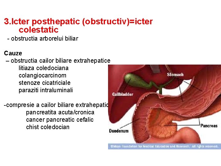 3. Icter posthepatic (obstructiv)=icter colestatic - obstructia arborelui biliar Cauze – obstructia cailor biliare