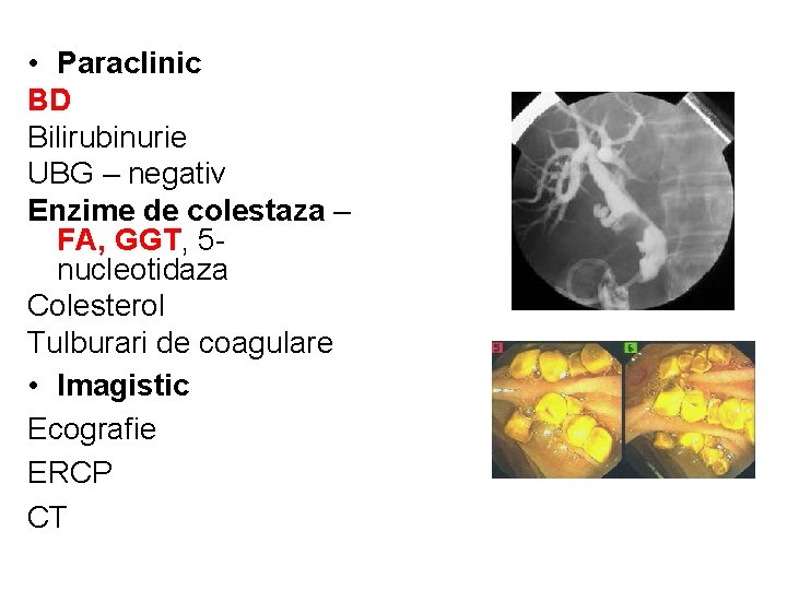  • Paraclinic BD Bilirubinurie UBG – negativ Enzime de colestaza – FA, GGT,