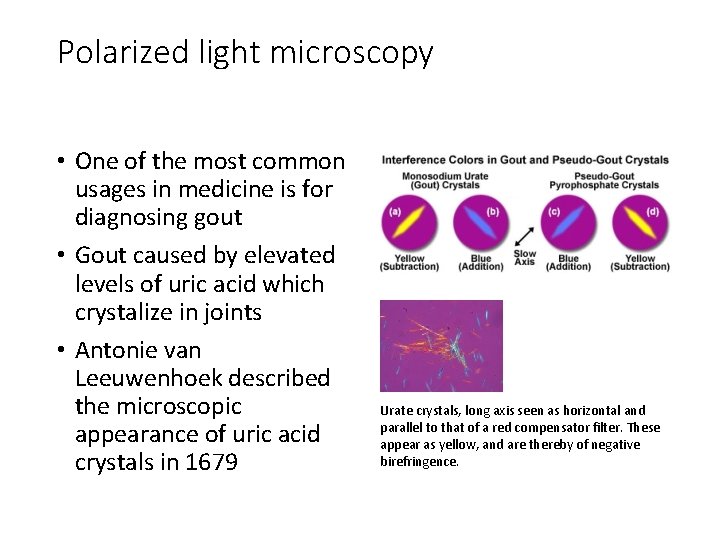 Polarized light microscopy • One of the most common usages in medicine is for