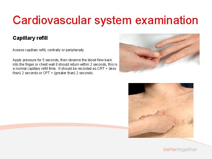 Cardiovascular system examination Capillary refill Assess capillary refill, centrally or peripherally. Apply pressure for