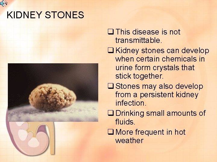 KIDNEY STONES q This disease is not transmittable. q Kidney stones can develop when