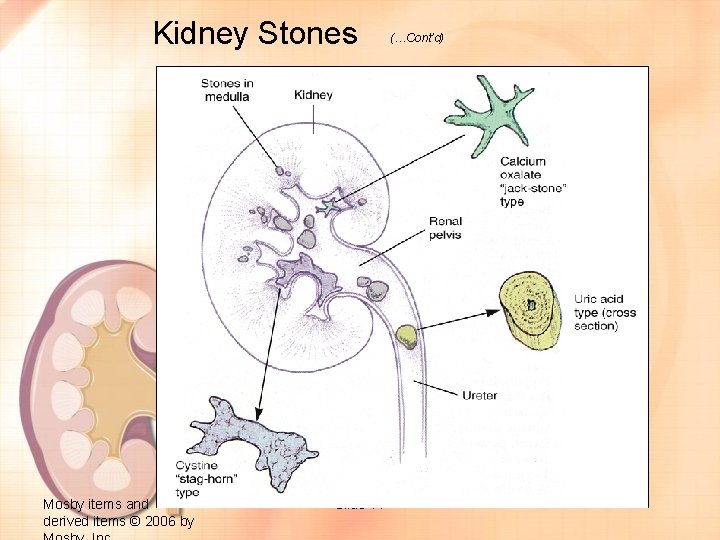 Kidney Stones Mosby items and derived items © 2006 by Slide 77 (…Cont’d) 