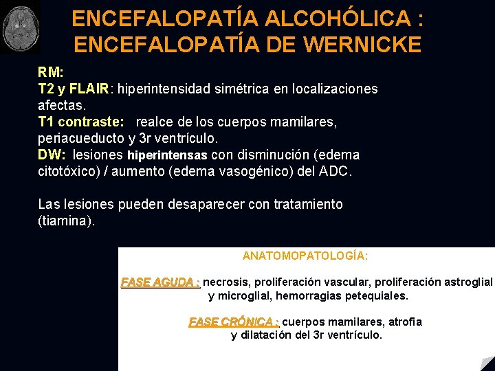 ENCEFALOPATÍA ALCOHÓLICA : ENCEFALOPATÍA DE WERNICKE RM: T 2 y FLAIR: hiperintensidad simétrica en