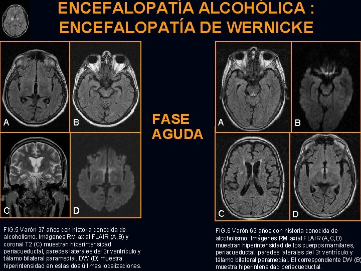 ENCEFALOPATÍA ALCOHÓLICA : ENCEFALOPATÍA DE WERNICKE A B C D FIG. 5 Varón 37