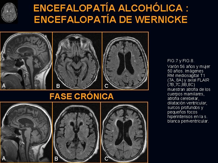 ENCEFALOPATÍA ALCOHÓLICA : ENCEFALOPATÍA DE WERNICKE A B C FASE CRÓNICA A B C