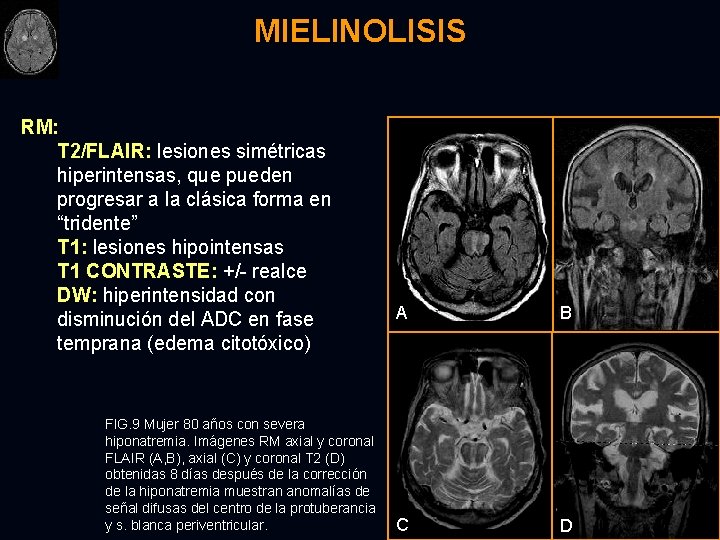 MIELINOLISIS RM: T 2/FLAIR: lesiones simétricas hiperintensas, que pueden progresar a la clásica forma