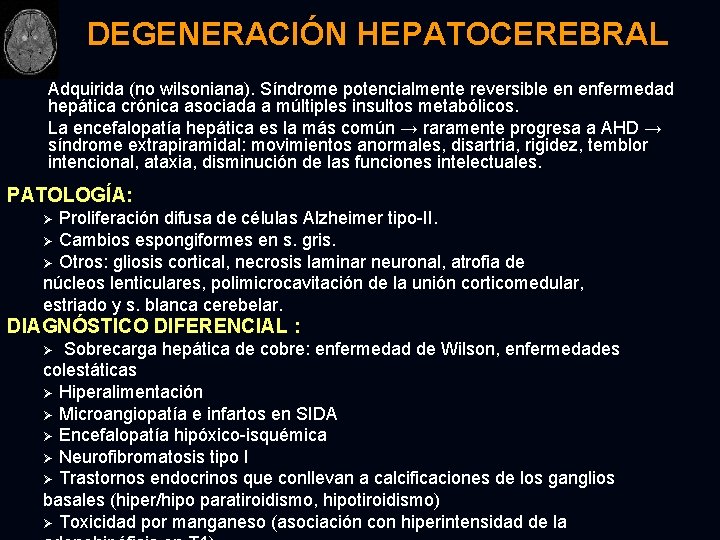 DEGENERACIÓN HEPATOCEREBRAL Adquirida (no wilsoniana). Síndrome potencialmente reversible en enfermedad hepática crónica asociada a