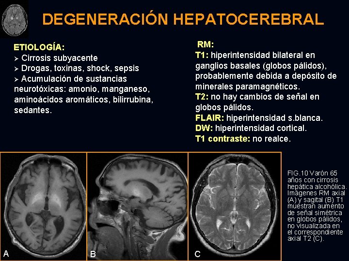 DEGENERACIÓN HEPATOCEREBRAL ETIOLOGÍA: Ø Cirrosis subyacente Ø Drogas, toxinas, shock, sepsis Ø Acumulación de