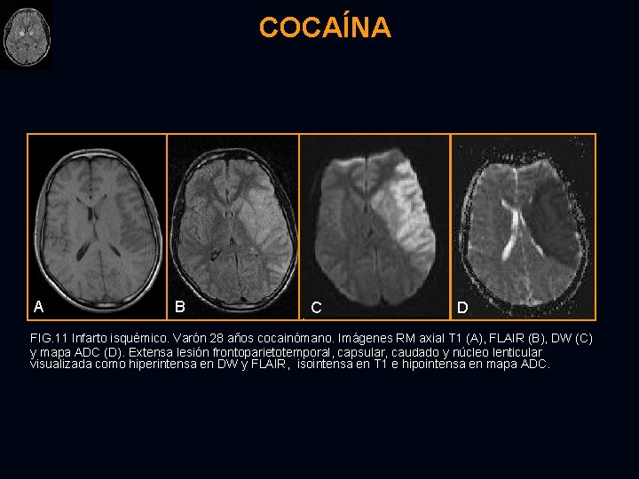 COCAÍNA A B C D FIG. 11 Infarto isquémico. Varón 28 años cocainómano. Imágenes