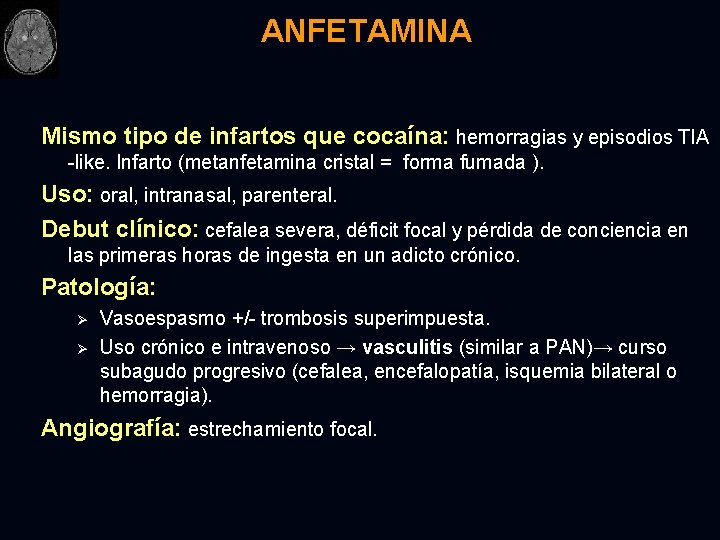 ANFETAMINA Mismo tipo de infartos que cocaína: hemorragias y episodios TIA -like. Infarto (metanfetamina