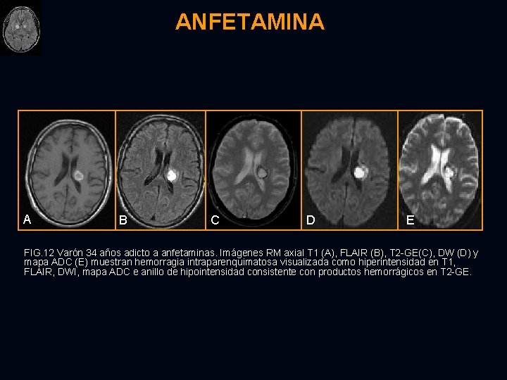 ANFETAMINA A B C D E FIG. 12 Varón 34 años adicto a anfetaminas.