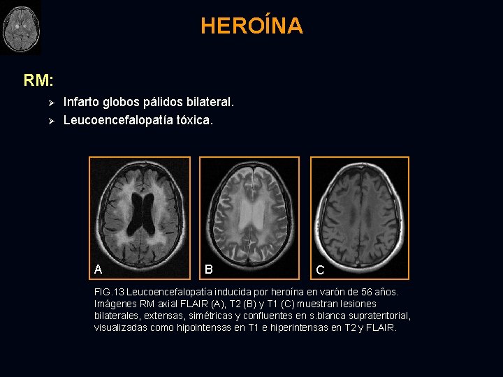 HEROÍNA RM: Ø Ø Infarto globos pálidos bilateral. Leucoencefalopatía tóxica. A B C FIG.