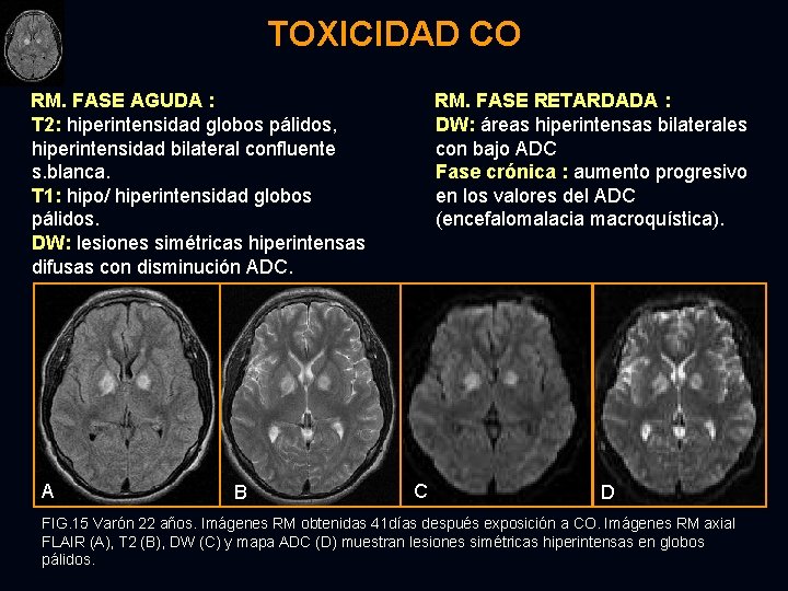 TOXICIDAD CO RM. FASE AGUDA : T 2: hiperintensidad globos pálidos, hiperintensidad bilateral confluente