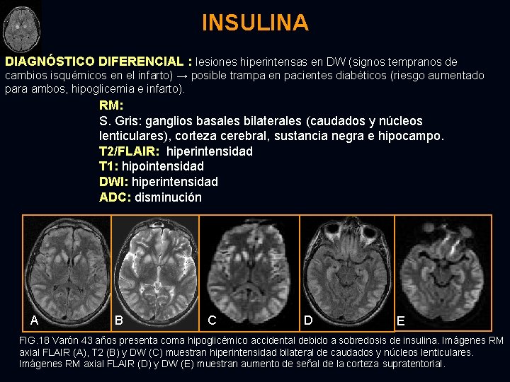 INSULINA DIAGNÓSTICO DIFERENCIAL : lesiones hiperintensas en DW (signos tempranos de cambios isquémicos en