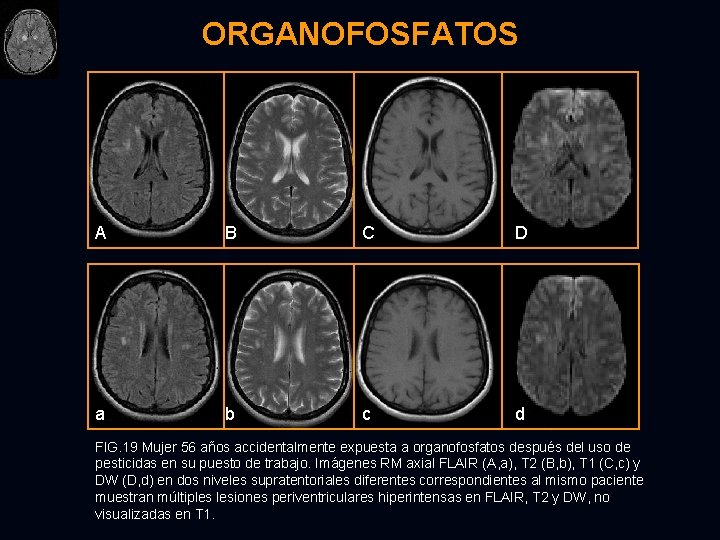 ORGANOFOSFATOS A B C D a b c d FIG. 19 Mujer 56 años