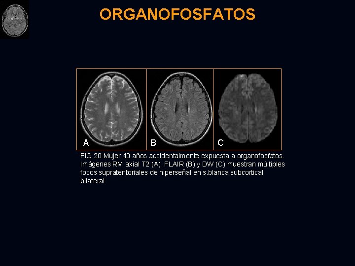 ORGANOFOSFATOS A B C FIG. 20 Mujer 40 años accidentalmente expuesta a organofosfatos. Imágenes