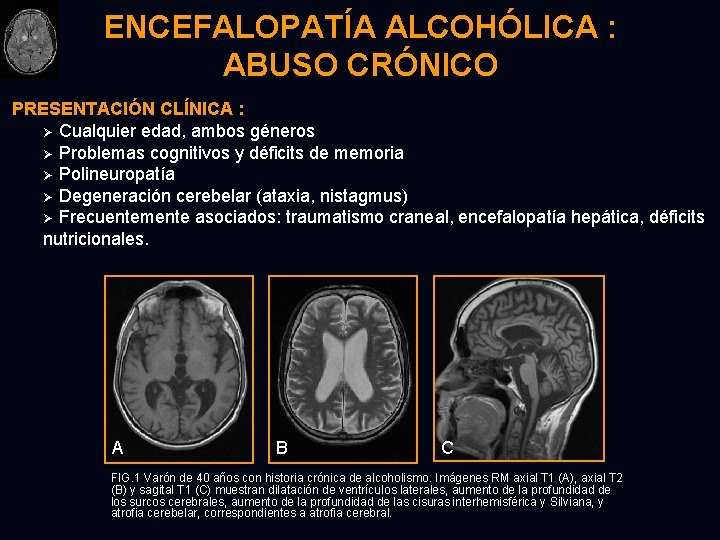 ENCEFALOPATÍA ALCOHÓLICA : ABUSO CRÓNICO PRESENTACIÓN CLÍNICA : Ø Cualquier edad, ambos géneros Ø