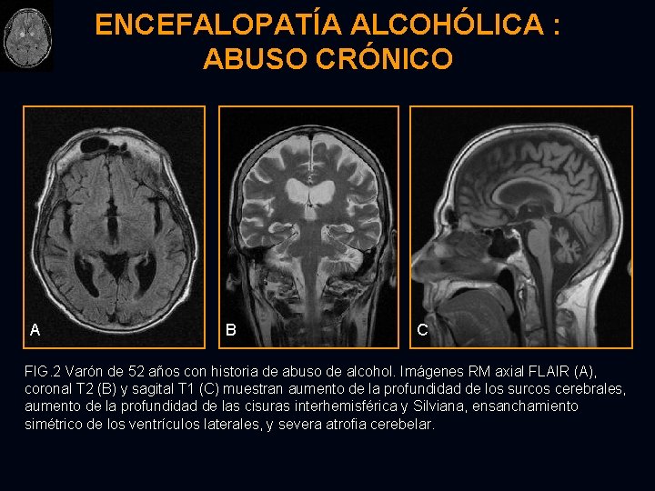 ENCEFALOPATÍA ALCOHÓLICA : ABUSO CRÓNICO A B C FIG. 2 Varón de 52 años