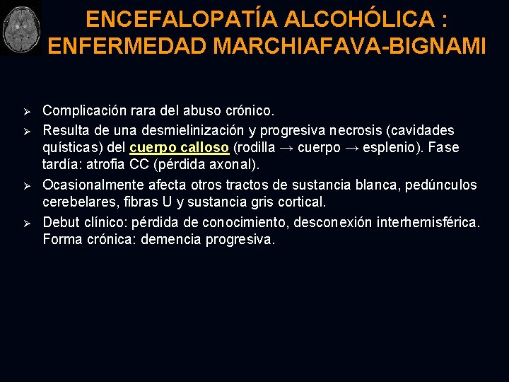 ENCEFALOPATÍA ALCOHÓLICA : ENFERMEDAD MARCHIAFAVA-BIGNAMI Ø Ø Complicación rara del abuso crónico. Resulta de