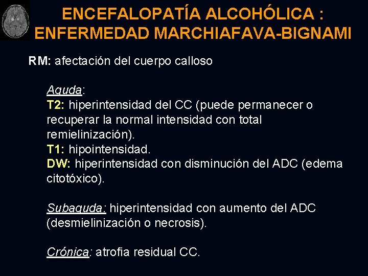 ENCEFALOPATÍA ALCOHÓLICA : ENFERMEDAD MARCHIAFAVA-BIGNAMI RM: afectación del cuerpo calloso Aguda: T 2: hiperintensidad