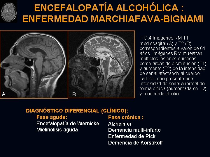 ENCEFALOPATÍA ALCOHÓLICA : ENFERMEDAD MARCHIAFAVA-BIGNAMI A B FIG. 4 Imágenes RM T 1 mediosagital