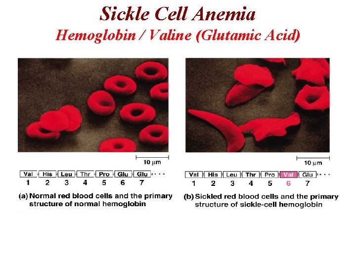 Sickle Cell Anemia Hemoglobin / Valine (Glutamic Acid) Sickle Cell Anemia Hemoglobin / Valine (Glutamic Acid)