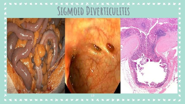 Sigmoid Diverticulitis 19 