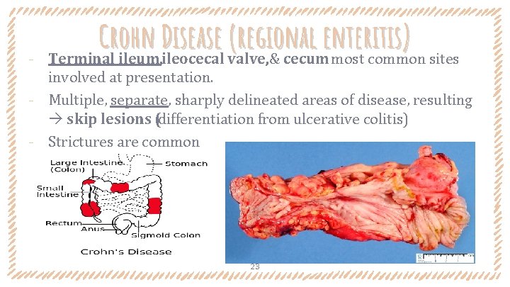 ‐ Crohn Disease (regional enteritis) Terminal ileum, ileocecal valve, & cecum most common sites