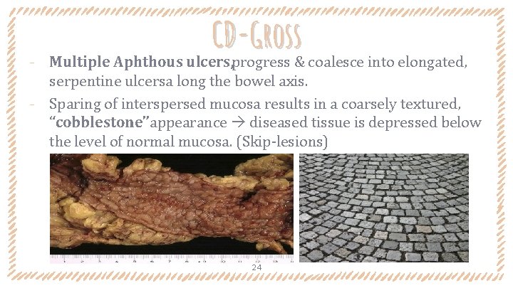 CD-Gross ‐ Multiple Aphthous ulcers, progress & coalesce into elongated, serpentine ulcersa long the