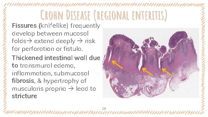 Crohn Disease (regional enteritis) Fissures (knifelike) frequently develop between mucosal folds extend deeply risk