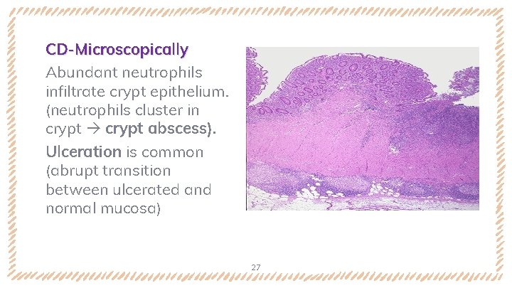 CD-Microscopically Abundant neutrophils infiltrate crypt epithelium. (neutrophils cluster in crypt abscess). Ulceration is common