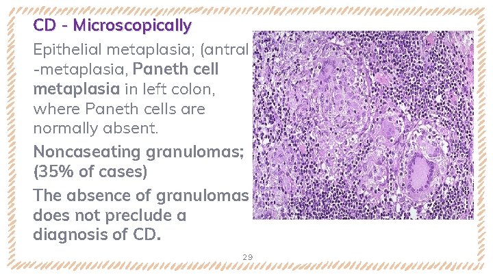 CD - Microscopically Epithelial metaplasia; (antral -metaplasia, Paneth cell metaplasia in left colon, where