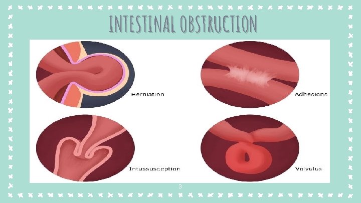 INTESTINAL OBSTRUCTION 3 