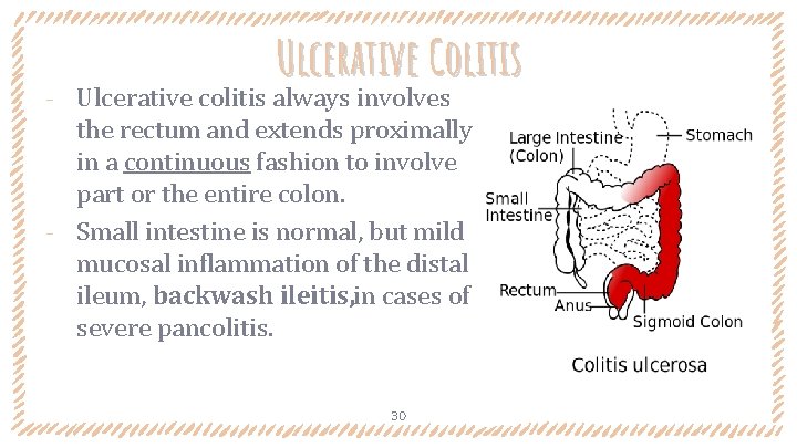 Ulcerative Colitis Ulcerative colitis always involves the rectum and extends proximally in a continuous