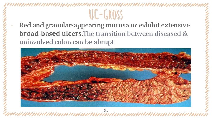 ‐ UC-Gross Red and granular-appearing mucosa or exhibit extensive broad-based ulcers. The transition between