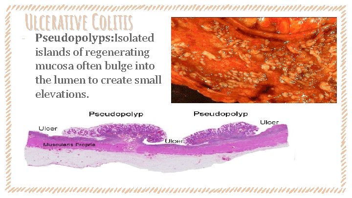 Ulcerative Colitis ‐ Pseudopolyps: Isolated islands of regenerating mucosa often bulge into the lumen