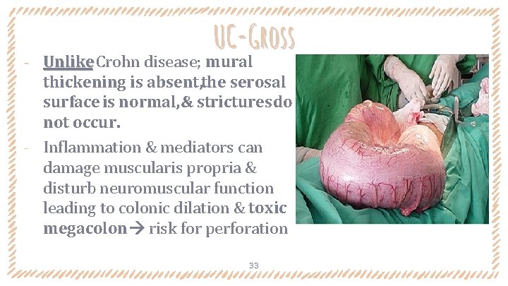 UC-Gross Unlike Crohn disease; mural thickening is absent, the serosal surface is normal, &