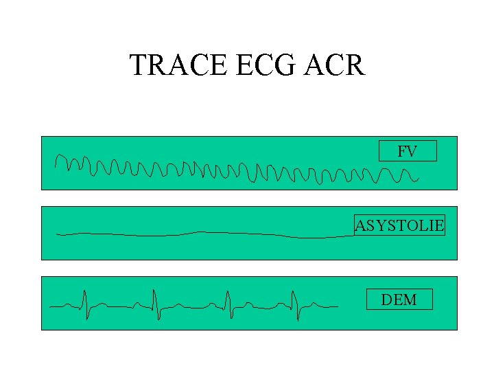 TRACE ECG ACR FV ASYSTOLIE DEM 
