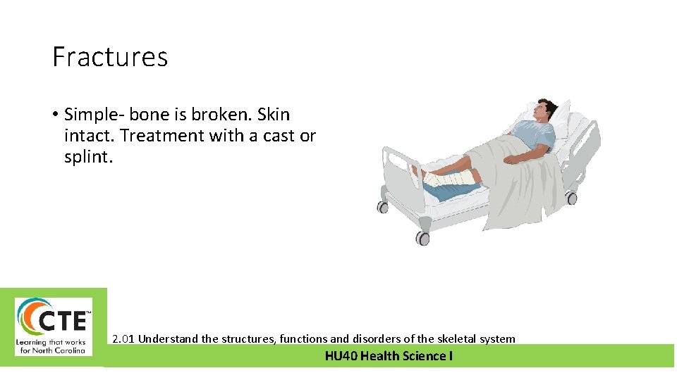 Fractures • Simple- bone is broken. Skin intact. Treatment with a cast or splint.
