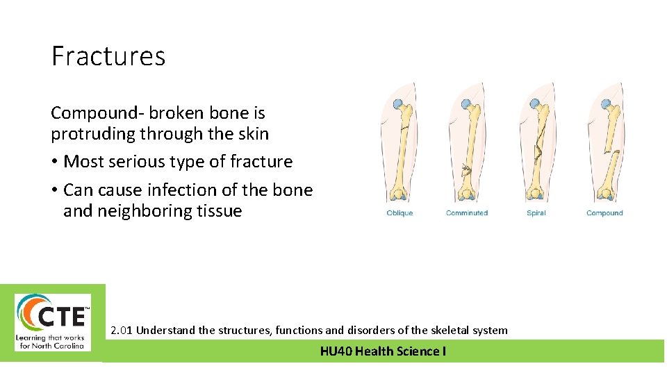 Fractures Compound- broken bone is protruding through the skin • Most serious type of