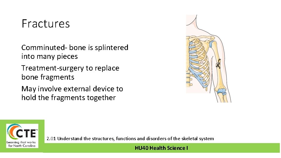 Fractures Comminuted- bone is splintered into many pieces Treatment-surgery to replace bone fragments May