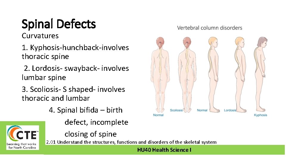 Spinal Defects Curvatures 1. Kyphosis-hunchback-involves thoracic spine 2. Lordosis- swayback- involves lumbar spine 3.