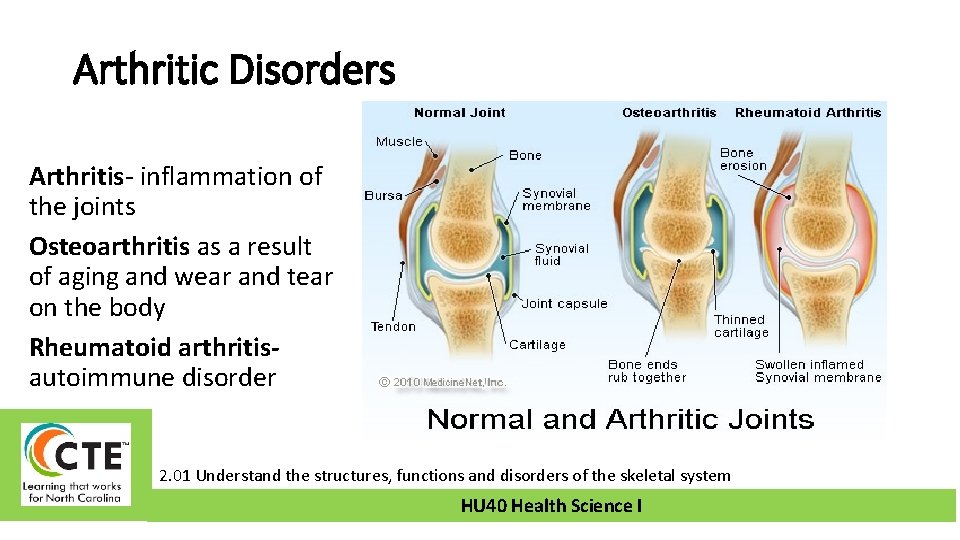 Arthritic Disorders Arthritis- inflammation of the joints Osteoarthritis as a result of aging and