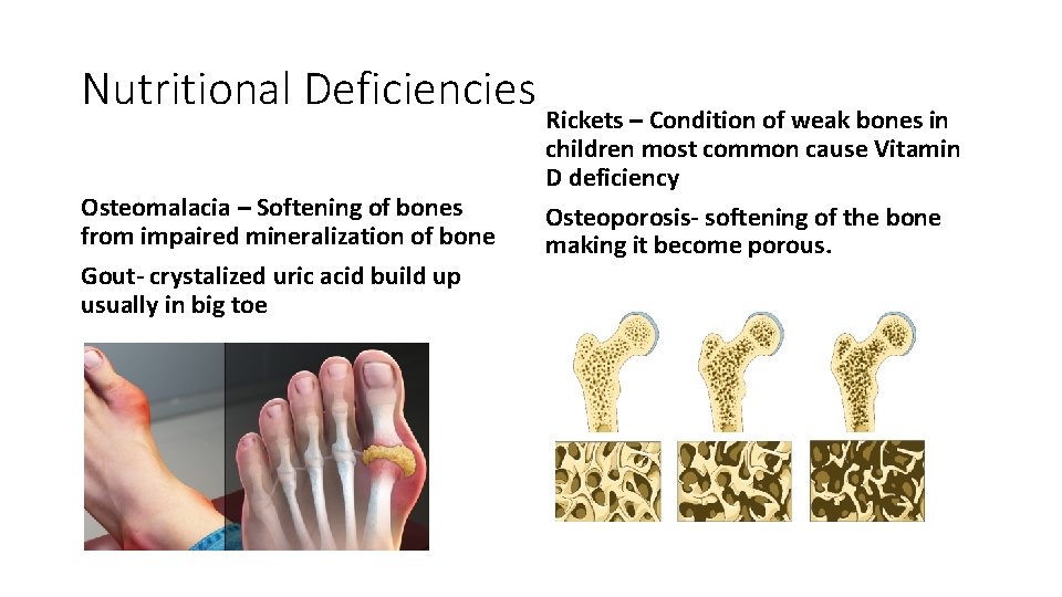 Nutritional Deficiencies Rickets – Condition of weak bones in Osteomalacia – Softening of bones