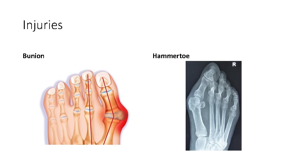 Injuries Bunion Hammertoe 