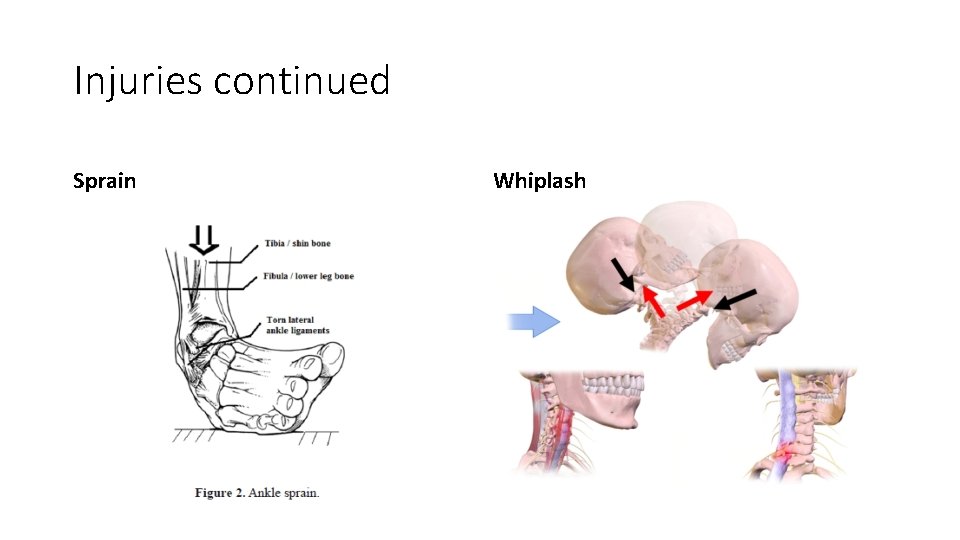 Injuries continued Sprain Whiplash 