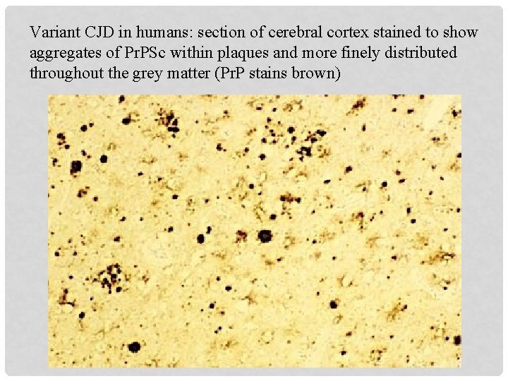 Variant CJD in humans: section of cerebral cortex stained to show aggregates of Pr.