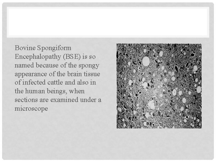 Bovine Spongiform Encephalopathy (BSE) is so named because of the spongy appearance of the