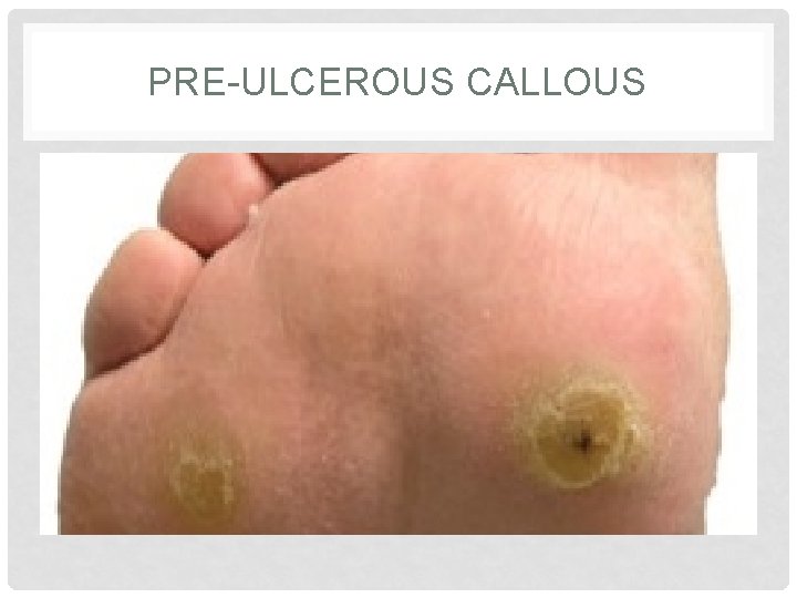 PRE-ULCEROUS CALLOUS 