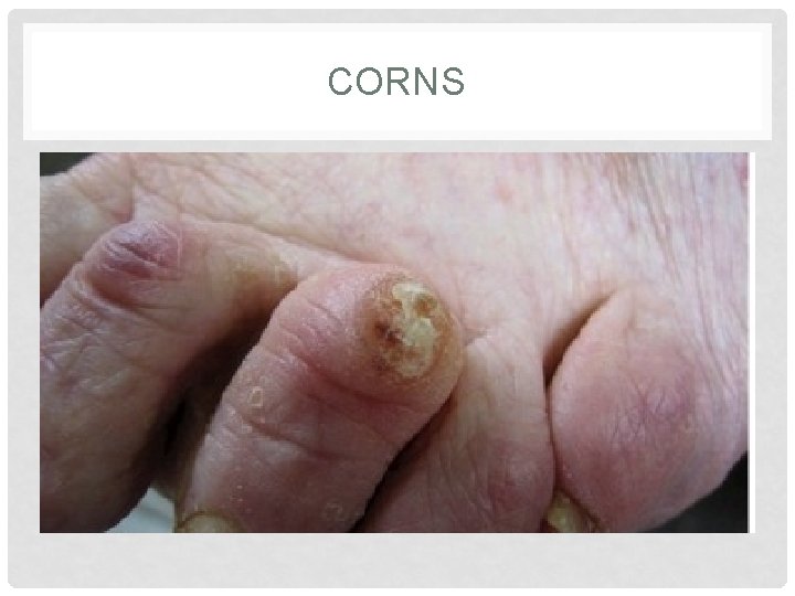 CORNS 